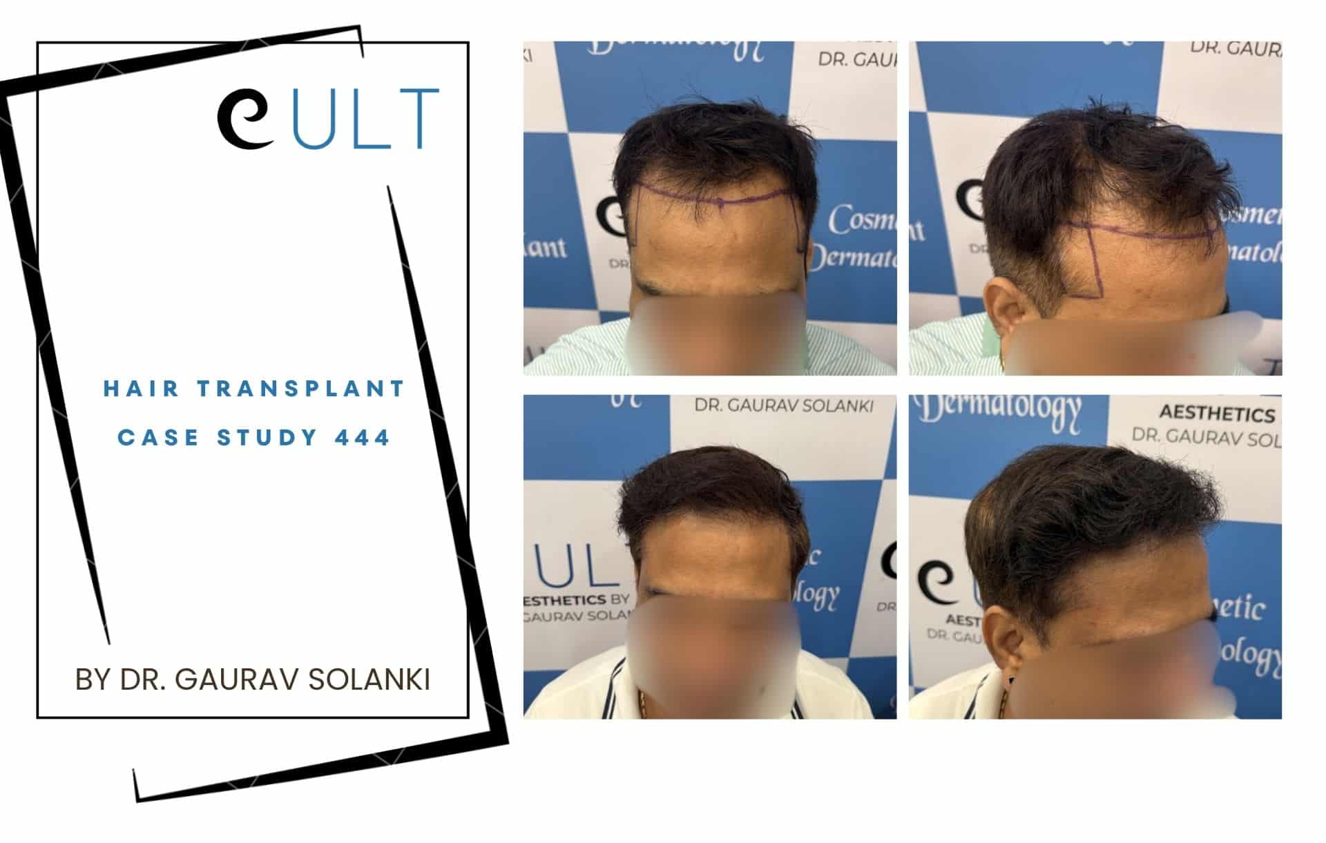 Cult Hair Transplant case study 444 by Dr. Gaurav Solanki; left panel is a graphic cover, right shows a four-photo collage of before/after hair transplant results.