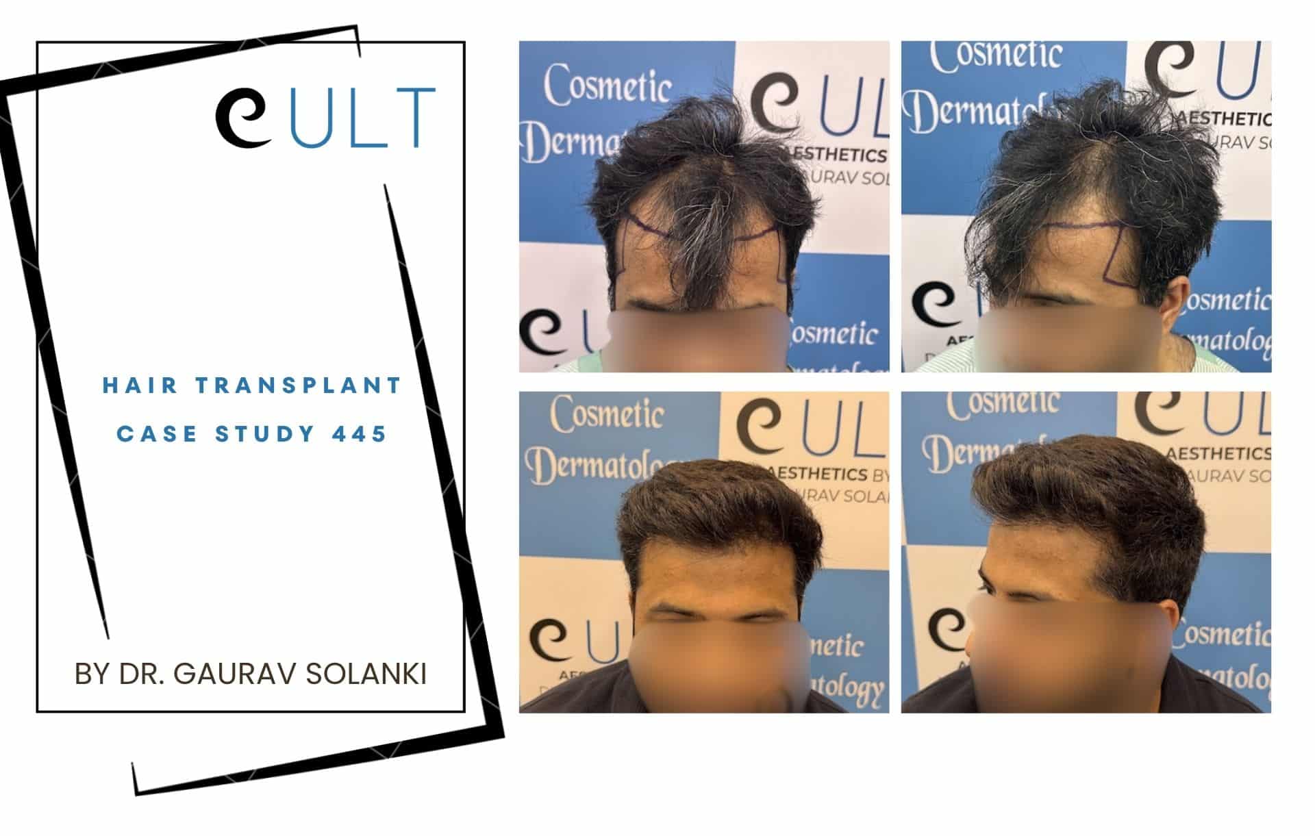 Cover page for 'Hair Transplant Case Study 445' next to a 2x3 grid of before/after hair restoration photos from a cosmetic dermatology clinic (faces blurred).