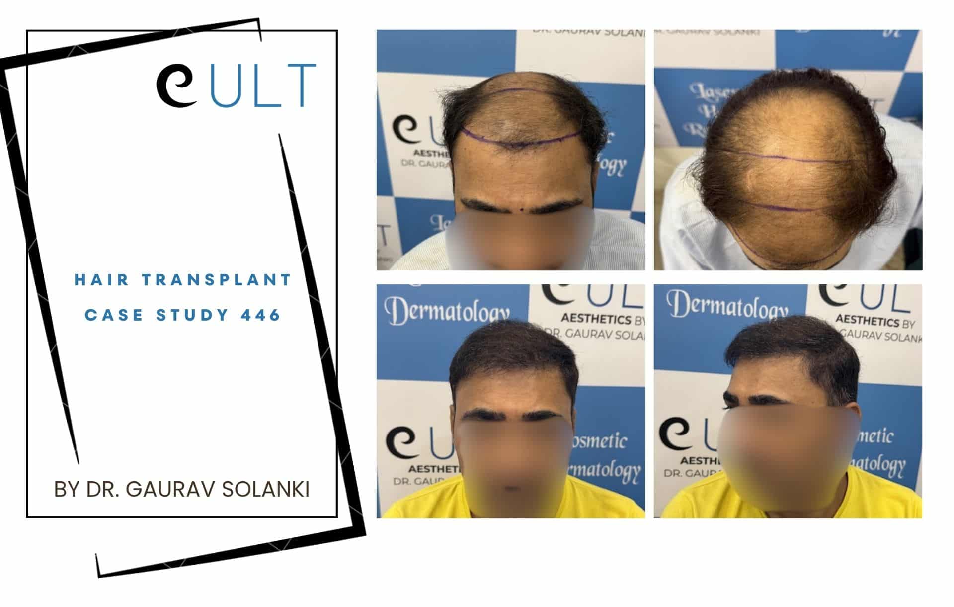 Left panel shows a hair transplant case study cover with 'eULT' branding and 'Hair Transplant Case Study 446'; right panel displays a 3x2 grid of patient photos with drawn hairlines.