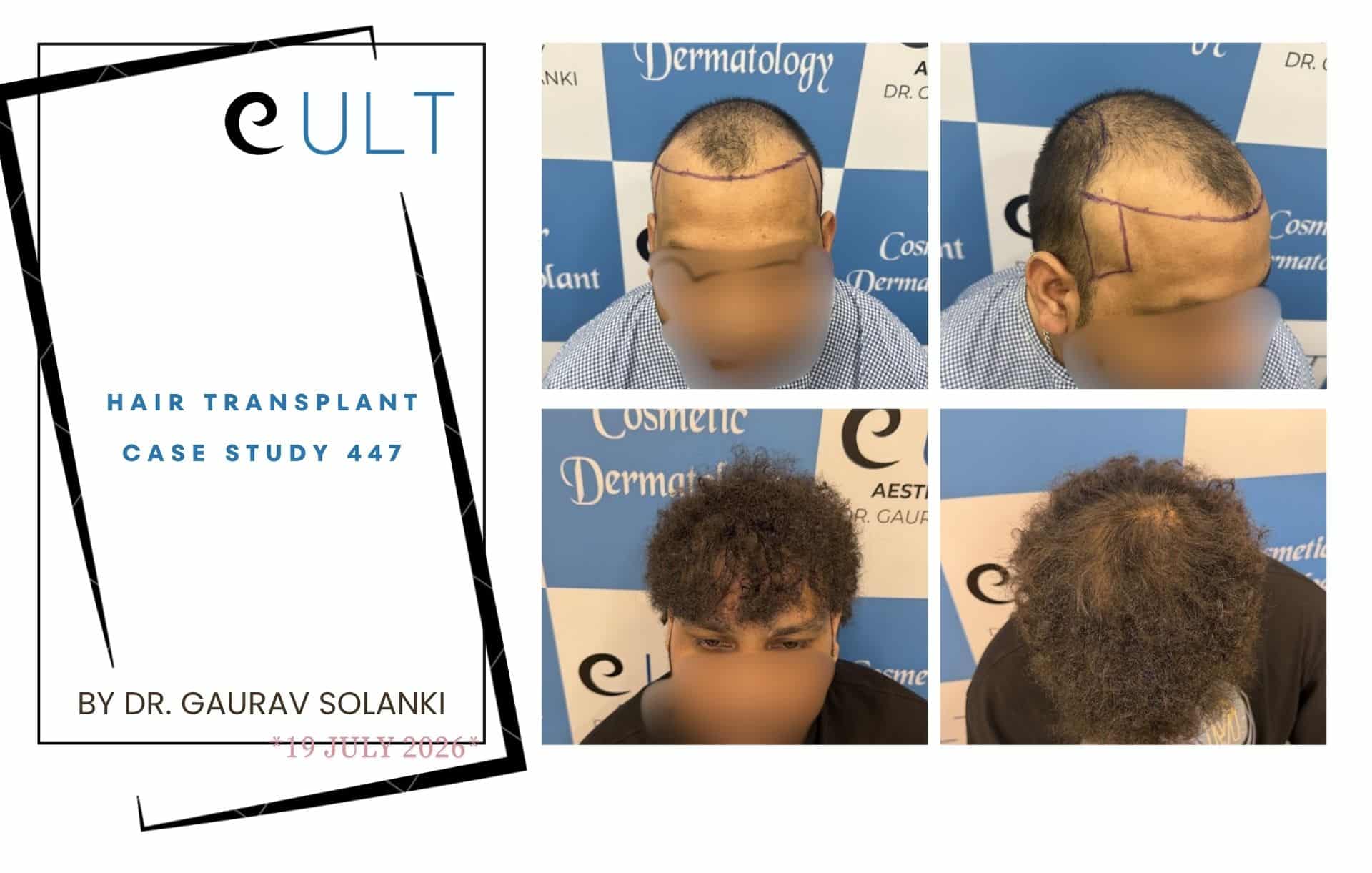 Hair Transplant case 301